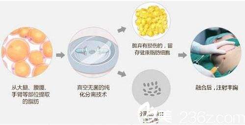 自体脂肪隆胸 彰显性感身材