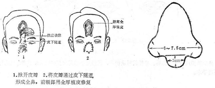 鼻再造术后护理要重视否则因小失大