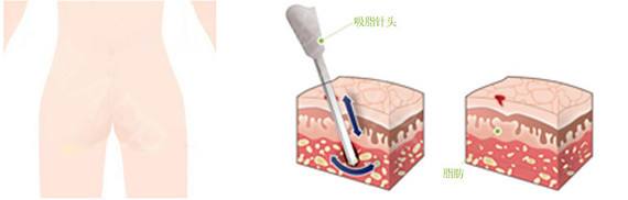 产后恢复整形让你秒变辣妈