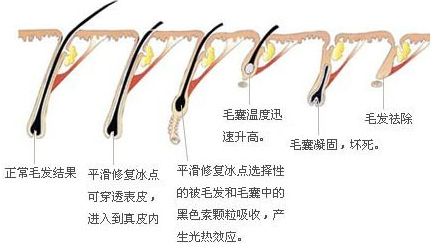 光子脱毛调节后千万不能疏于护理