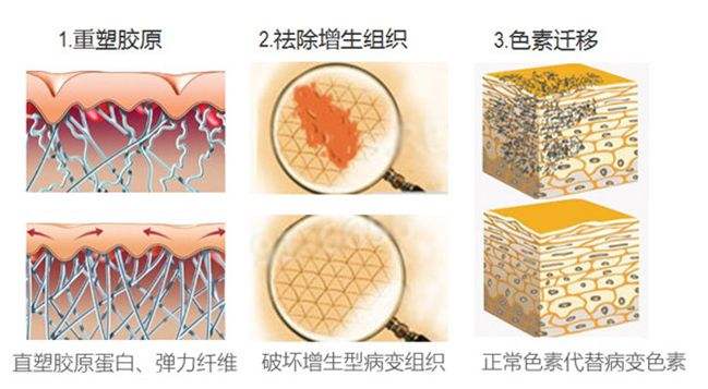 激光去疤痕不反弹促进皮肤再生