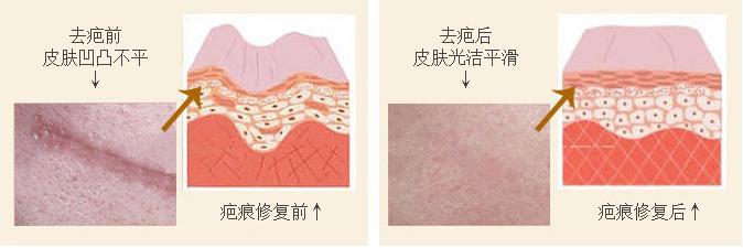 激光去疤痕不反弹促进皮肤再生