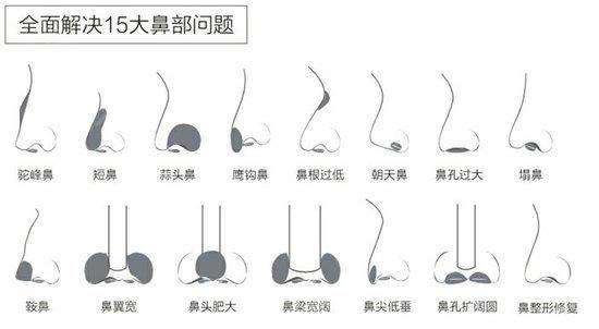 假体隆鼻果真实吗