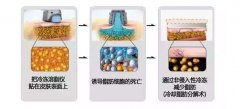 冷冻溶脂这种高大上操作的原理和果 width=