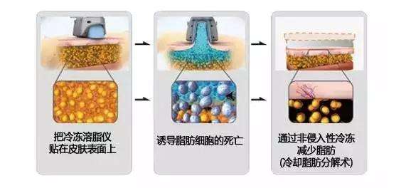 冷冻溶脂这种高大上操作的原理和果