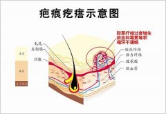 六点判断自己是不是疤痕体质 width=