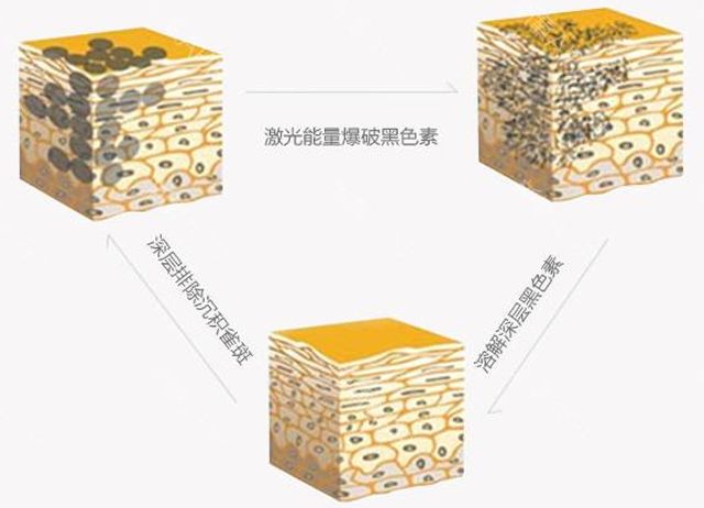 激光美肤祛斑三大优势还你白净脸蛋