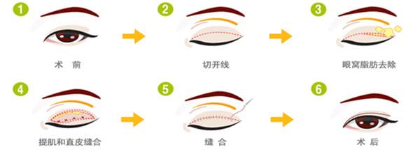 切开法做双眼皮有什么优势