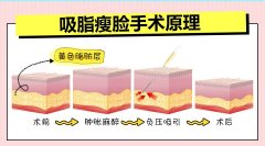 吸脂瘦脸后这些细节不能忽略 width=