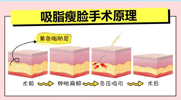 吸脂瘦脸后这些细节不能忽略