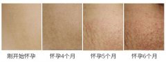 产后如何去妊娠纹？去妊娠纹的产品有哪些？ width=