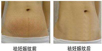 【产后如何去妊娠纹？去妊娠纹的产品有哪些？】