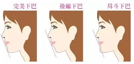 自体脂肪丰下巴塑造立体轮廓