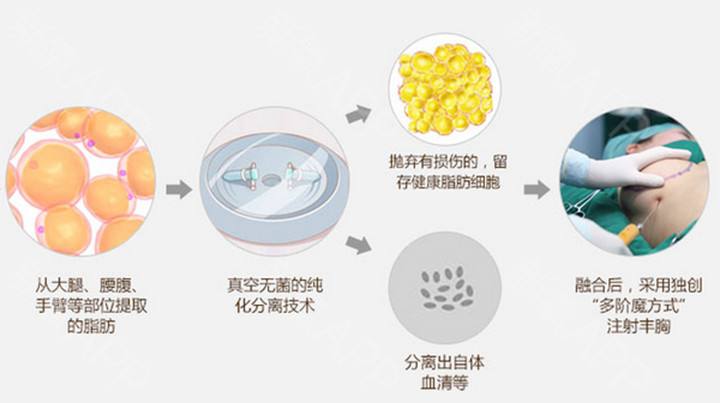 【自体脂肪隆胸手术的果好吗？有哪些优势？】