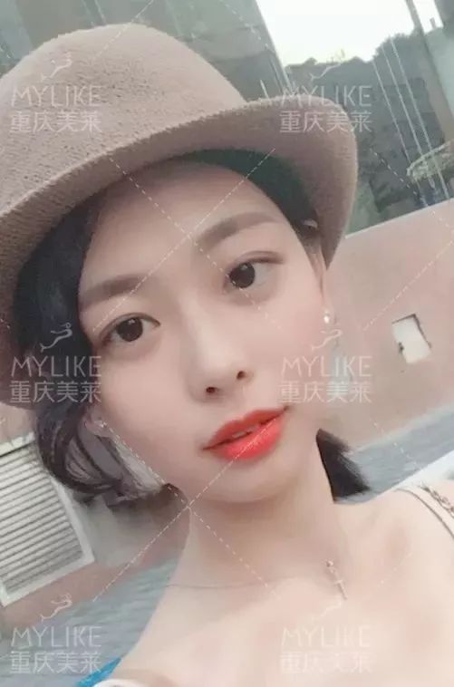 磨颧骨前后对比图，颧骨整形有失败案例吗？