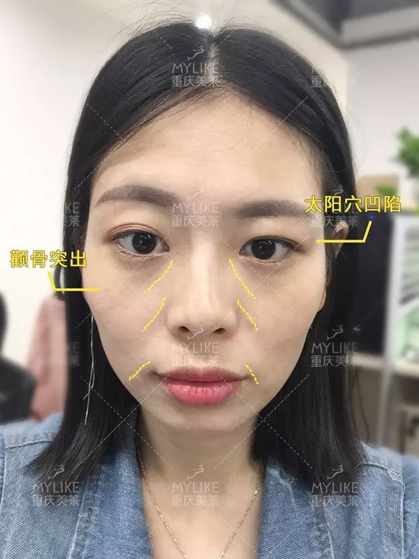 磨颧骨前后对比图，颧骨整形有失败案例吗？