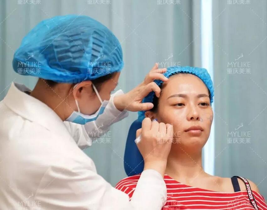 磨颧骨前后对比图，颧骨整形有失败案例吗？