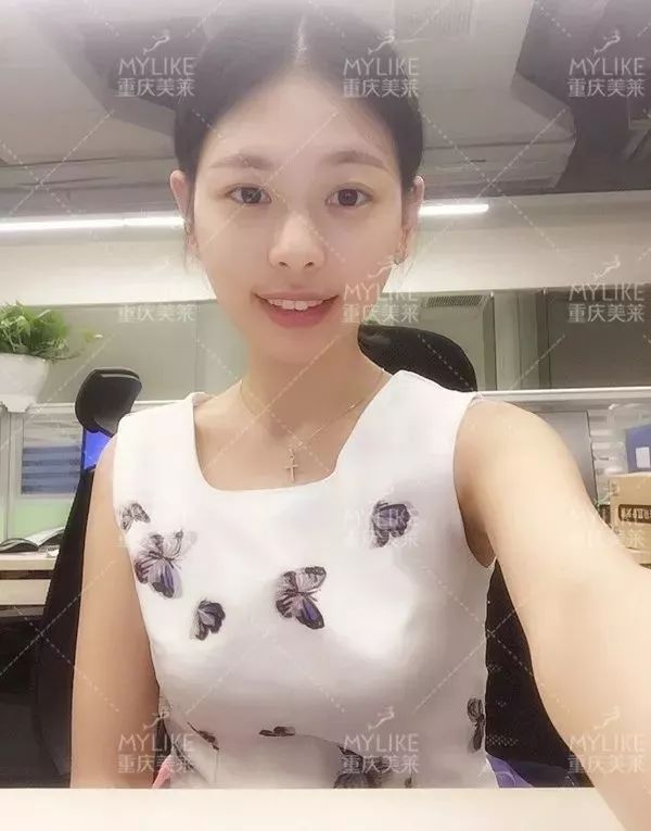 磨颧骨前后对比图，颧骨整形有失败案例吗？