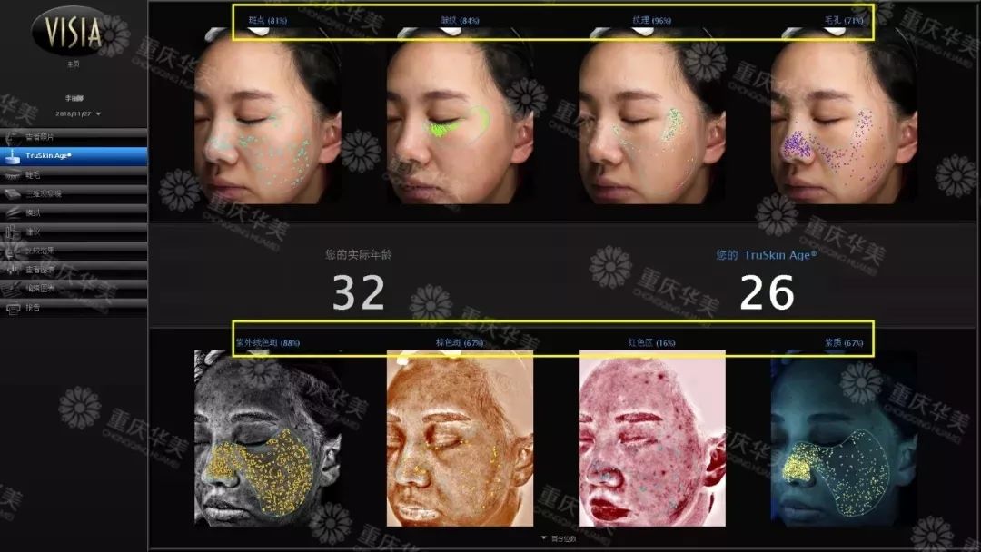 光魔动力分层祛斑：脸上有斑的女生，小心30岁的时候颜值崩掉！