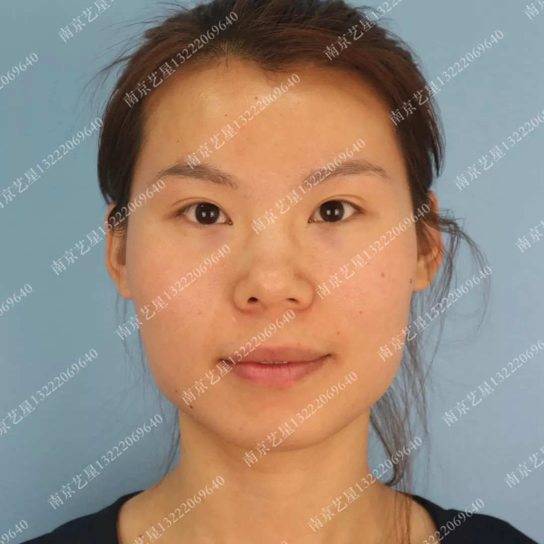 美杜莎美眼术真实案例分享，南京艺星做的~