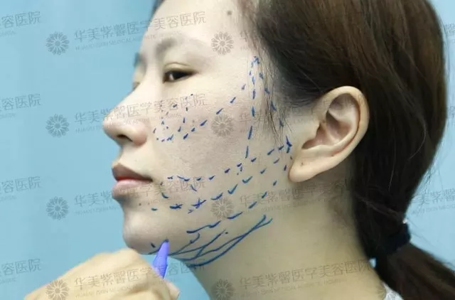 面部埋线提升提拉果好吗？面部埋线提升提拉果对比图~