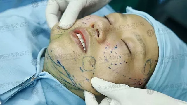 面部埋线提升提拉果好吗？面部埋线提升提拉果对比图~