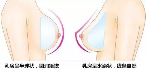 水滴型假体隆胸一个月果照片——南京艺星真实案例~ width=