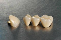 金钯合金烤瓷牙价格贵不贵哟? width=