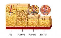 等离子激光溶脂果好吗?有好好? width=