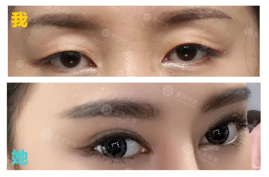春节后立马赶来做双眼皮的TA们，都有哪些扎心/暖心/揪心故事？ 