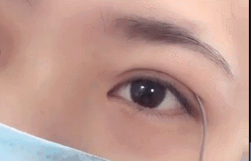 春节后立马赶来做双眼皮的TA们，都有哪些扎心/暖心/揪心故事？ 