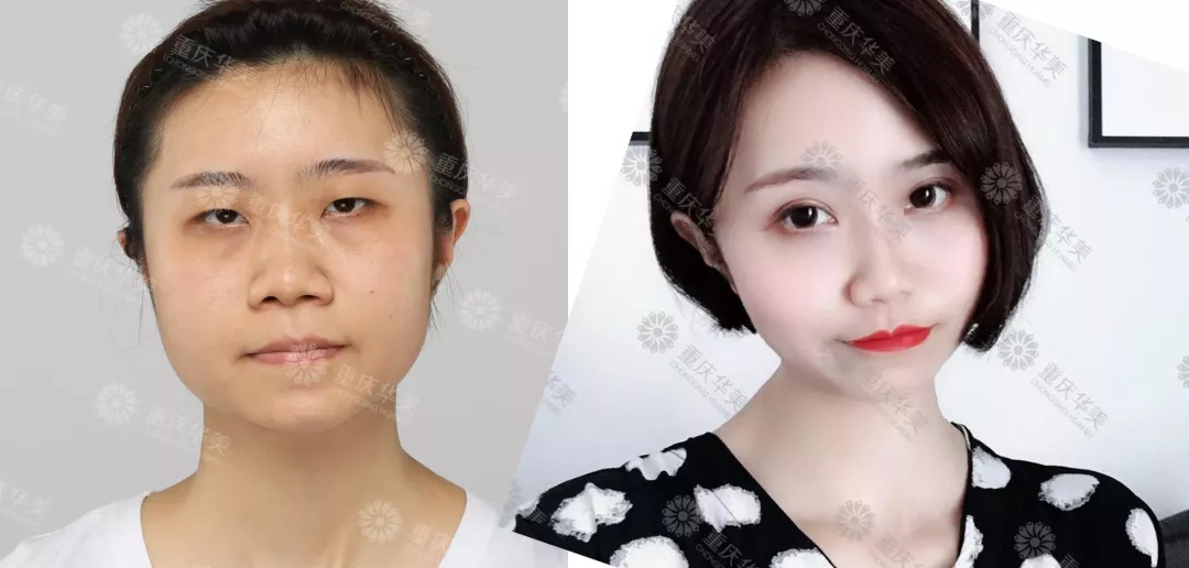 春节后立马赶来做双眼皮的TA们，都有哪些扎心/暖心/揪心故事？ 