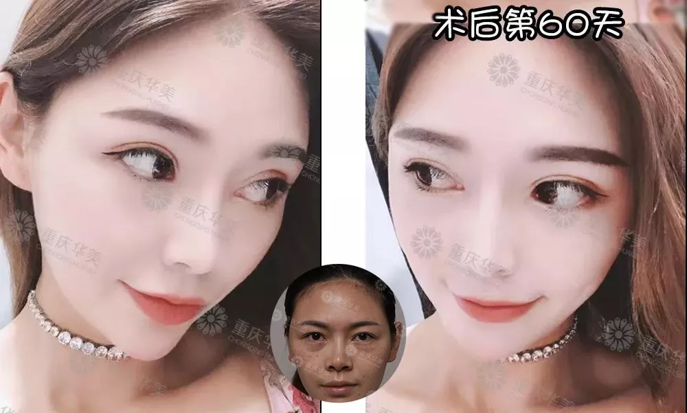 春节后立马赶来做双眼皮的TA们，都有哪些扎心/暖心/揪心故事？ 