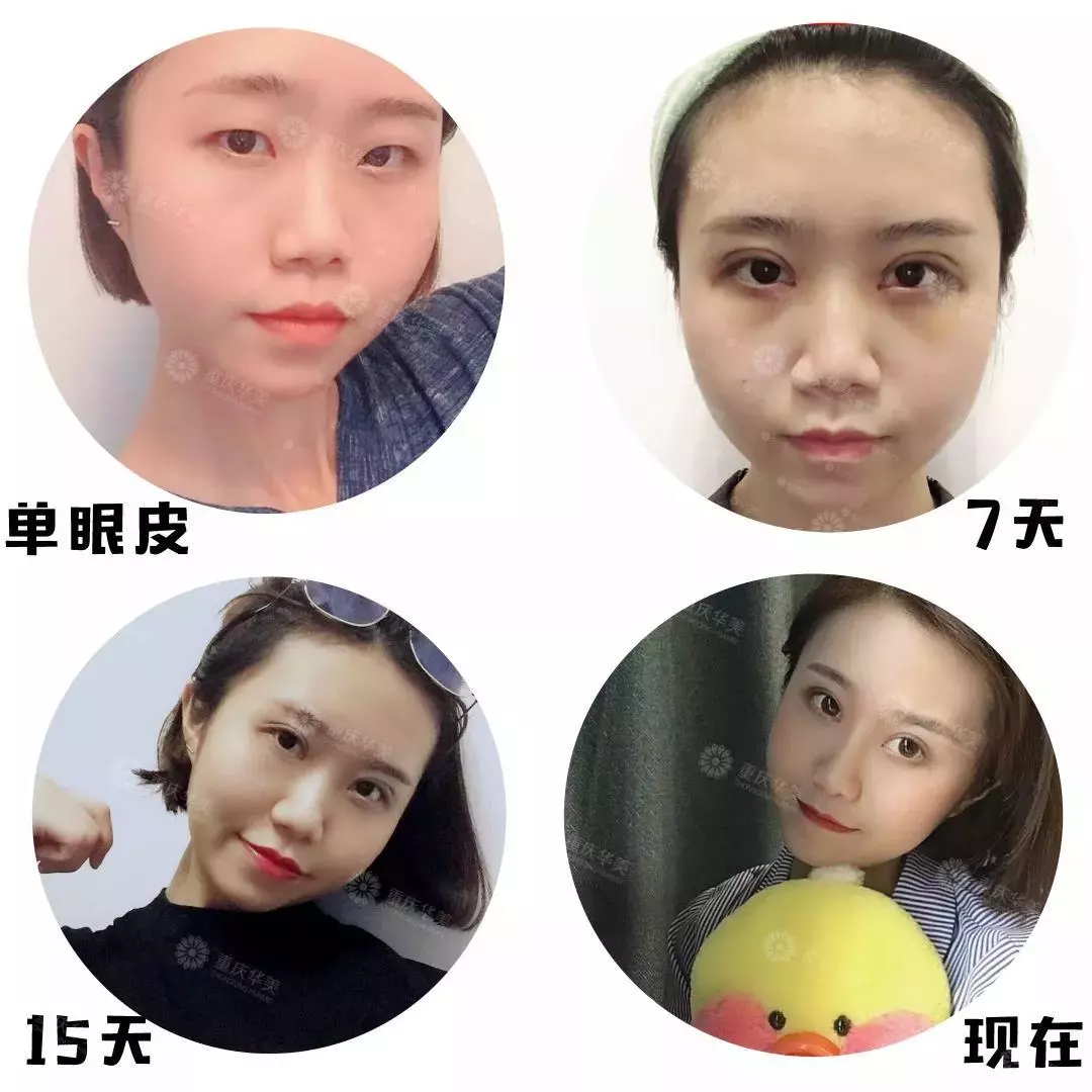 春节后立马赶来做双眼皮的TA们，都有哪些扎心/暖心/揪心故事？ 