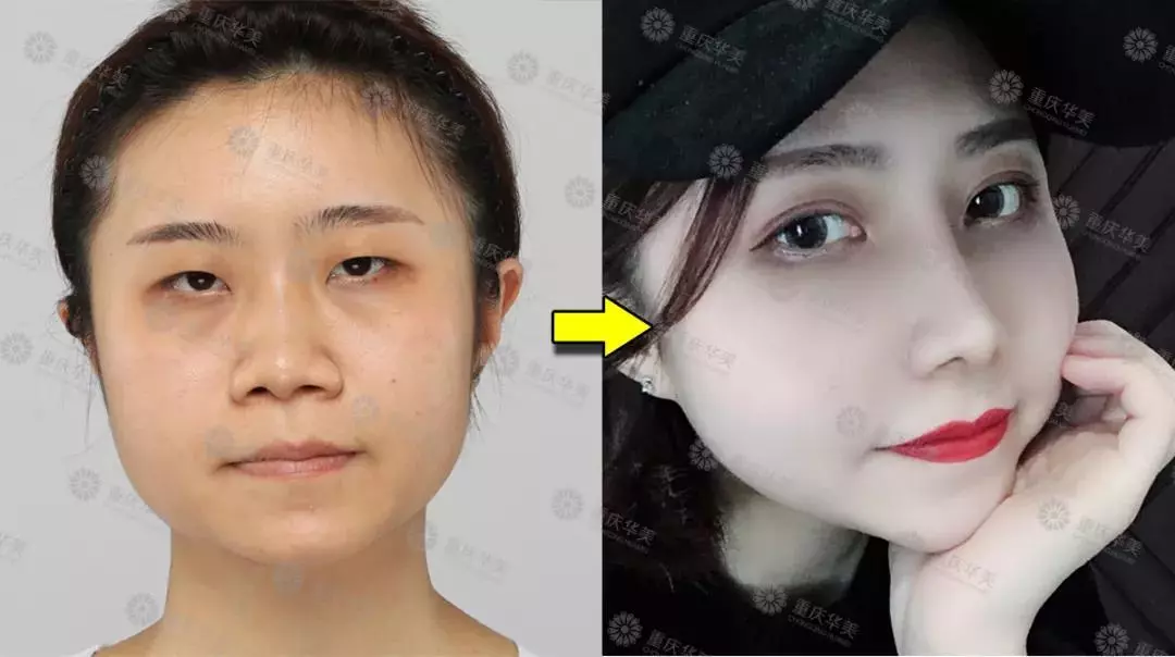 春节后立马赶来做双眼皮的TA们，都有哪些扎心/暖心/揪心故事？ 
