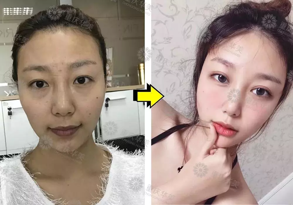 春节后立马赶来做双眼皮的TA们，都有哪些扎心/暖心/揪心故事？ 