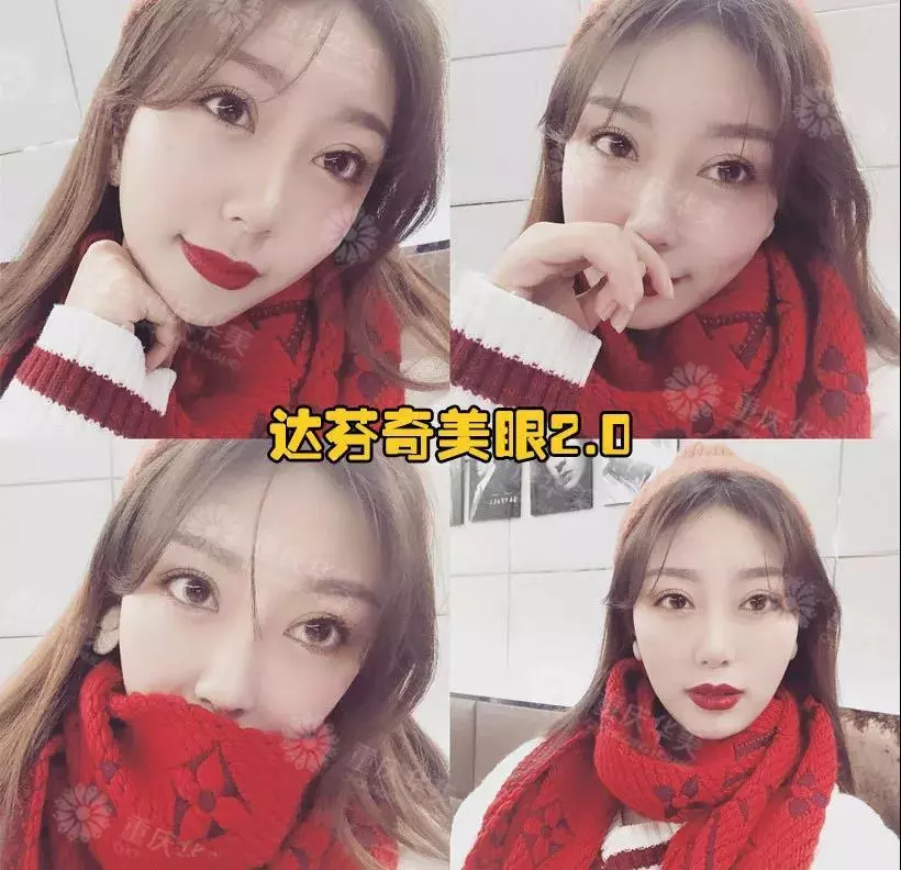 春节后立马赶来做双眼皮的TA们，都有哪些扎心/暖心/揪心故事？ 