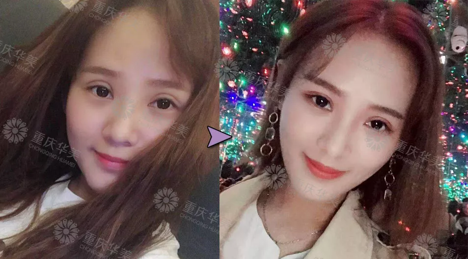 春节后立马赶来做双眼皮的TA们，都有哪些扎心/暖心/揪心故事？ 