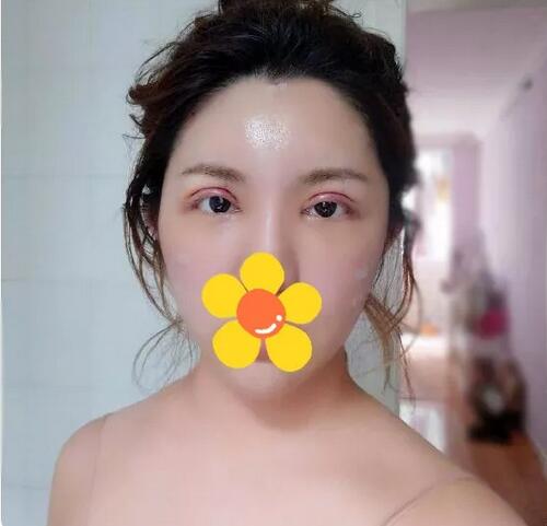 伊美尔cfs芭比大眼术+纳米脂肪混血脸2个月的果哦~