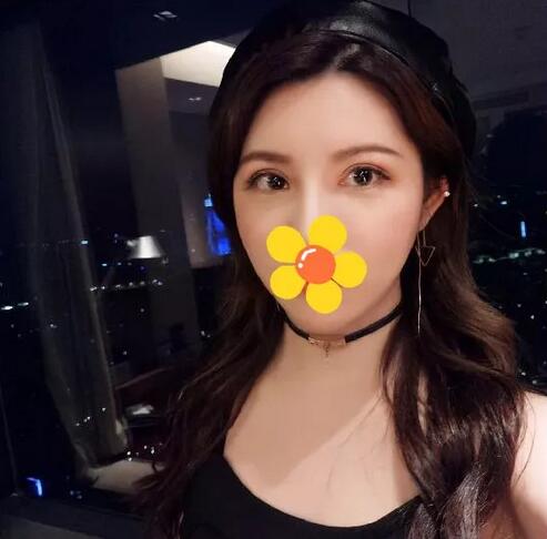 伊美尔cfs芭比大眼术+纳米脂肪混血脸2个月的果哦~