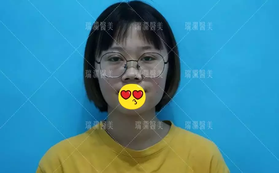 瑞澜芭比仿生俏鼻术案例罕见曝光，还不来围观？！