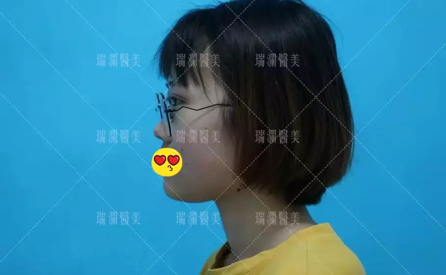 瑞澜芭比仿生俏鼻术案例罕见曝光，还不来围观？！
