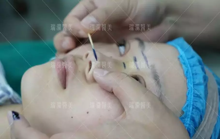 瑞澜芭比仿生俏鼻术案例罕见曝光，还不来围观？！