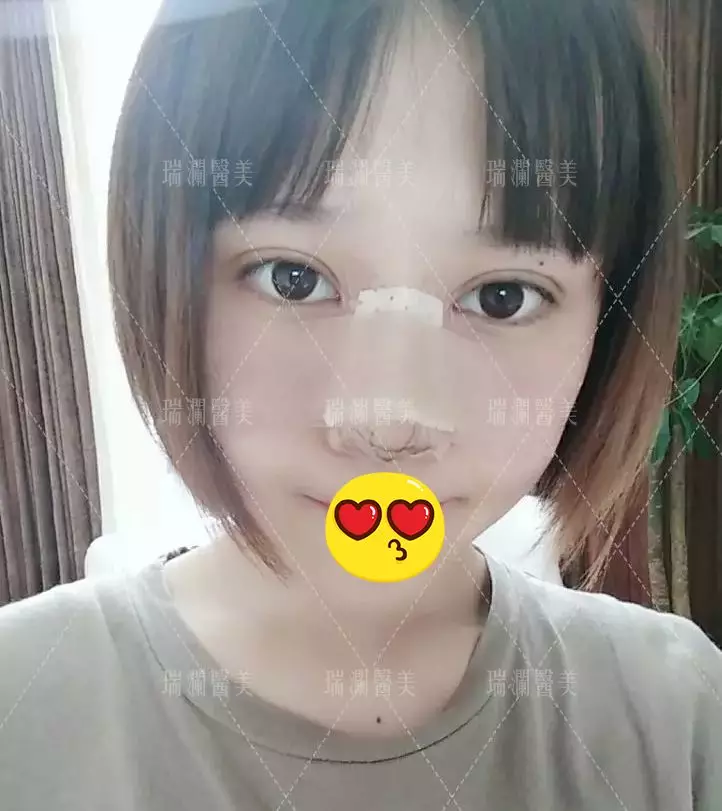 瑞澜芭比仿生俏鼻术案例罕见曝光，还不来围观？！