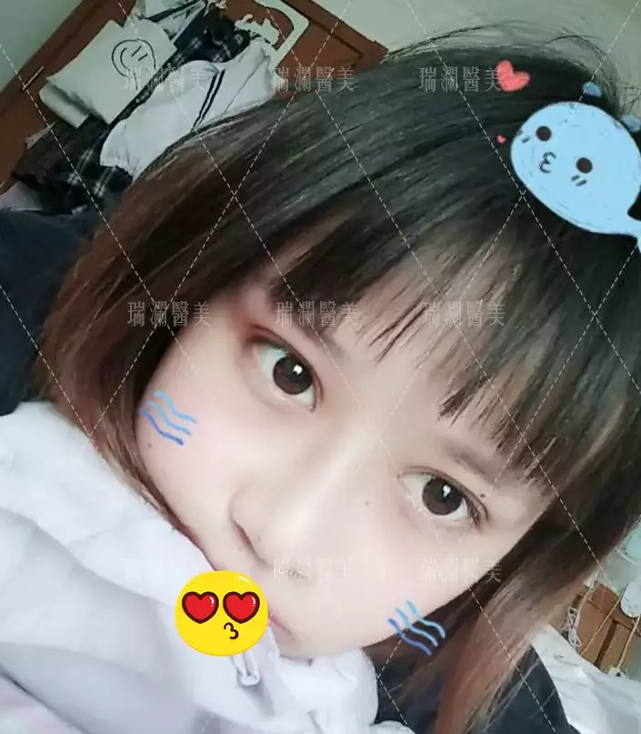 瑞澜芭比仿生俏鼻术案例罕见曝光，还不来围观？！ width=