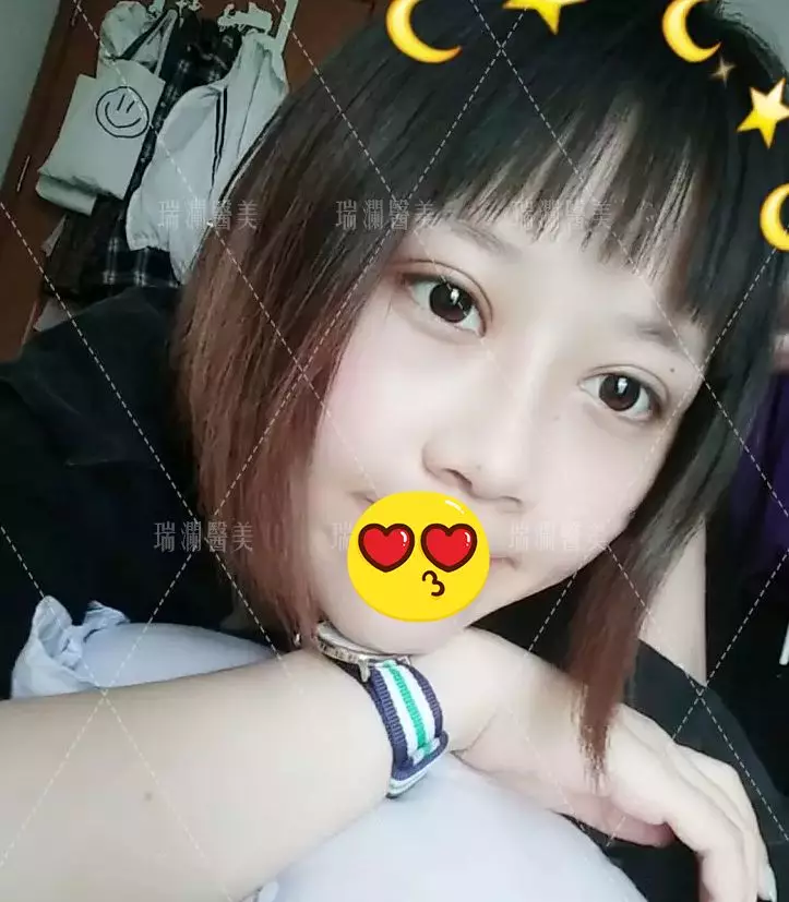 瑞澜芭比仿生俏鼻术案例罕见曝光，还不来围观？！