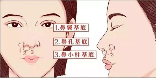 自体肋软骨隆鼻有后遗症吗？这则案例告诉你~
