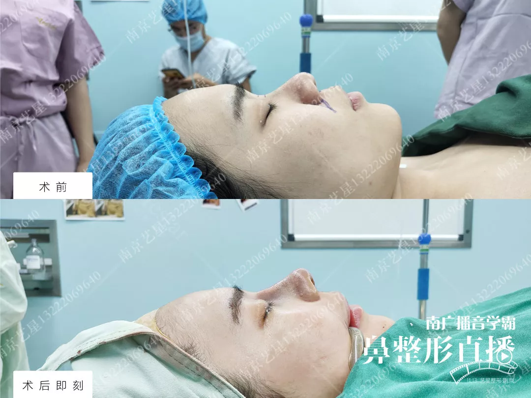 自体肋软骨隆鼻有后遗症吗？这则案例告诉你~