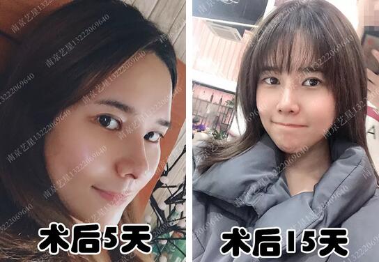 自体肋软骨隆鼻有后遗症吗？这则案例告诉你~