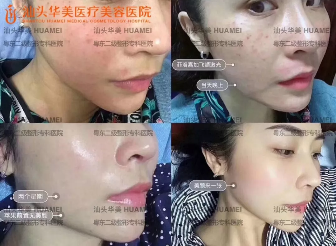 水光补水多少钱？法国抗衰产品+激光美肤激光祛斑果图一览~